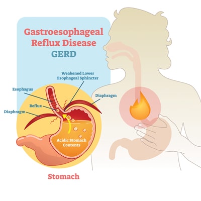 GERD or known as acid reflux gerd
