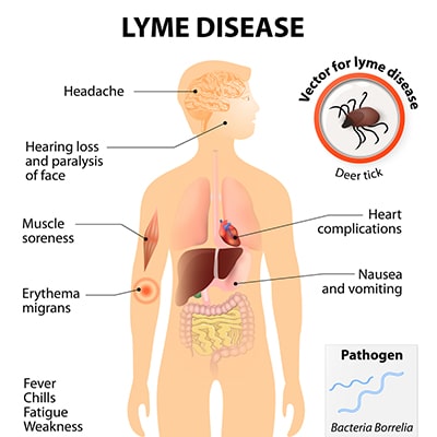 Lyme disease symptoms Lyme disease symptoms