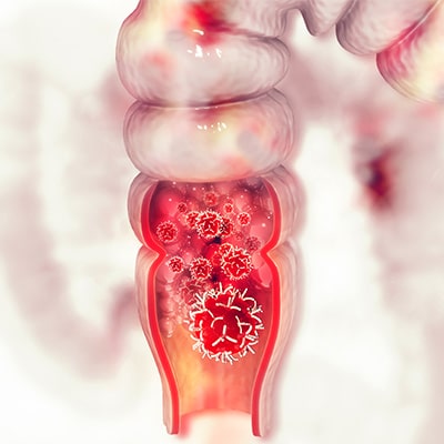 Colorectal Cancer Colorectal Cancer