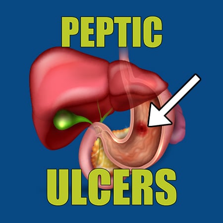 Peptic Ulcers